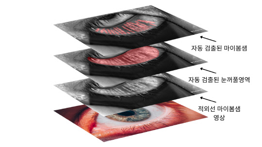 광주과학기술원은 적외선으로 촬영한 마이봄샘 영상을 AI를 활용해 자동 분석하는 '안구건조증 AI 판독기술'을 개발했다.  GIST 제공
